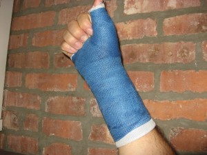 broken-wrist-blue-cast